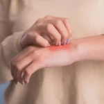 atopinis-dermatitas-jo-stadijos-ir-kaip-palengvinti-simptomus.webp.webp
